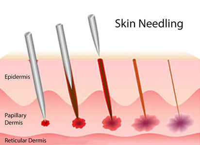 Skin Needling